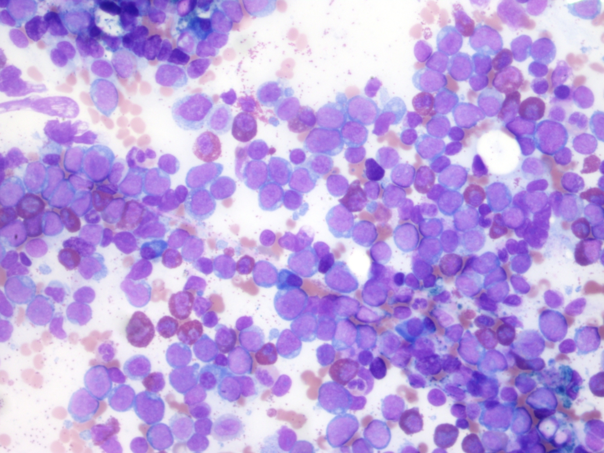 Initial bone marrow aspirate 20x
